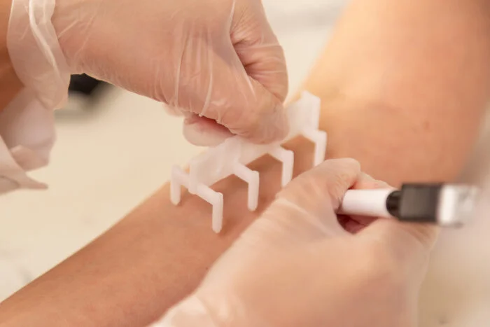 Realização de Prick Test para investigação de alergias
